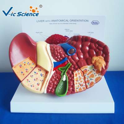 High Quality  Medical Liver Cancer Teaching Model