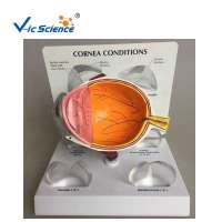 Medical  Cornea Pathological Eye model