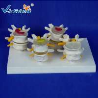 Medical lumbar Vertebral  Osteoarthritis Stage Model For Teaching