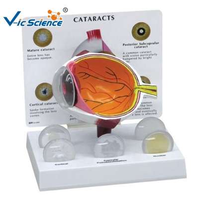 Eye Cataract  Model Medical Eye Cataract  imaging Anatomical model