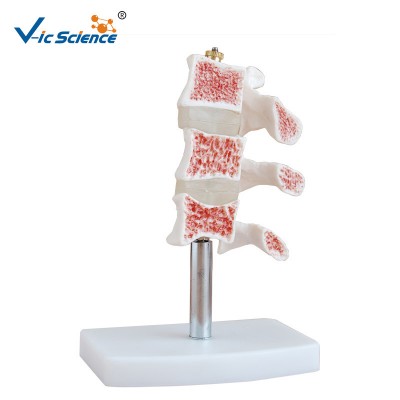 High Quality Life-Size Plastic Spine Cutaway Osteoporosis  Model